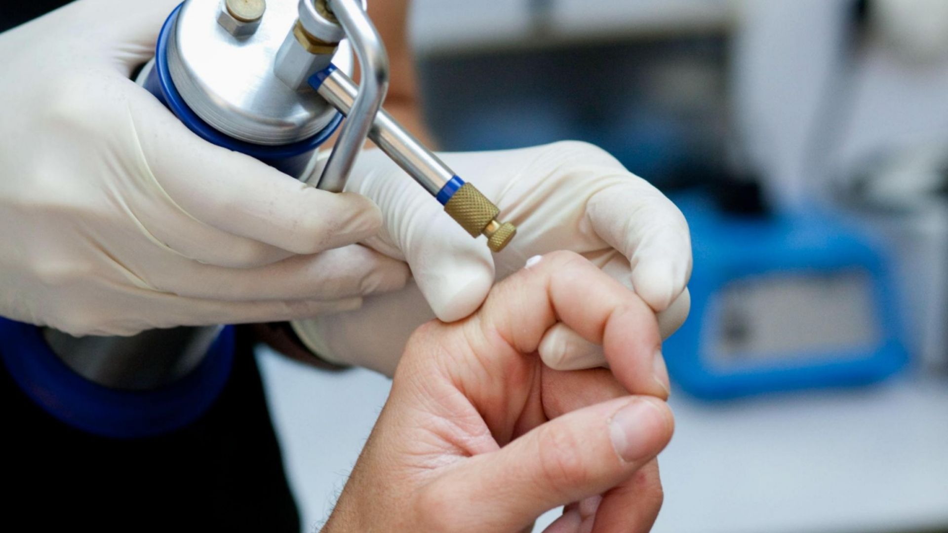 Удаление новообразований жидким азотом