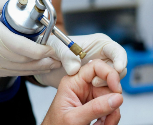 Криодеструкция новообразований